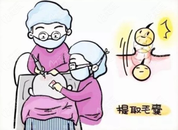 种植胸毛也是在后枕部提取毛囊