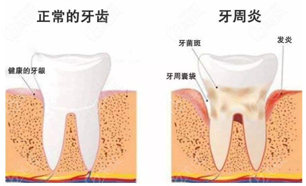 正常牙齿和牙齿有了牙周炎对比图
