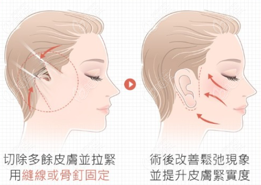 面部提升+颈部拉皮前后对比照
