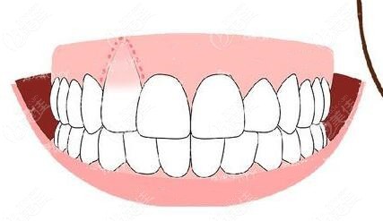 骨开窗—导致部分牙根在牙槽骨