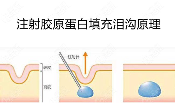 泪沟填充胶原蛋白的手术原理