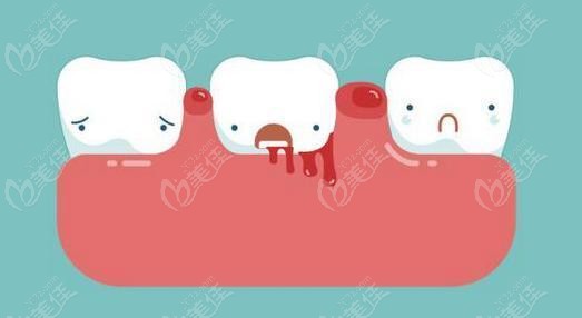 牙周炎早期的症状表现
