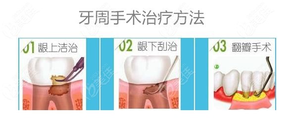 牙周疾病手术治疗方法
