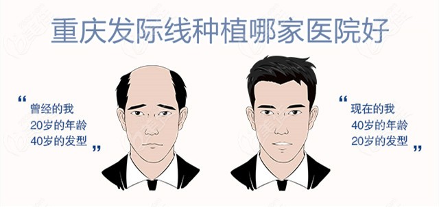 重庆发际线种植哪家好