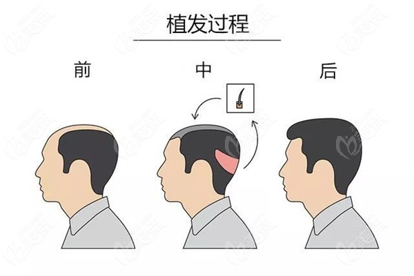 重庆做发际线修复过程