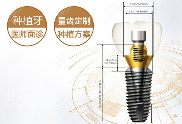 在温岭牙科医院做一颗种植牙多少钱