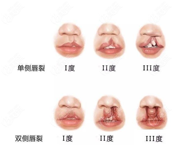 单侧和双侧唇裂一度二度和三度的区别