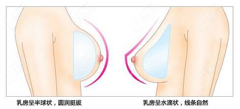 水滴型假体和圆型隆胸对比图