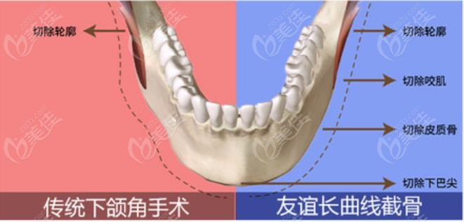 传统下颌角截骨手术和长曲线截骨的区别对比图