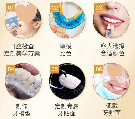 郑州植得口腔牙齿贴面流程