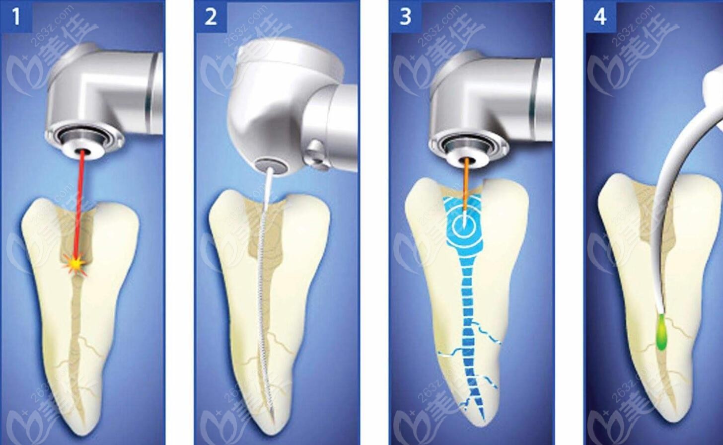 放大后的牙齒根管及治療過程 放大后的牙齒根管及治療過程