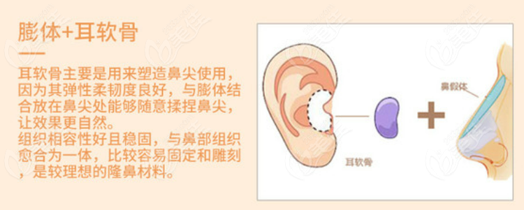 陈朋医生隆鼻的优势