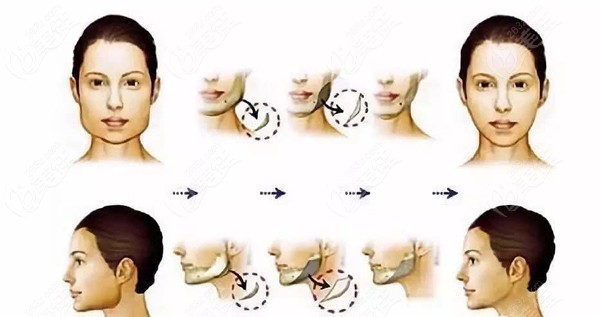 下颌角削骨手术改善的是侧脸突出骨骼
