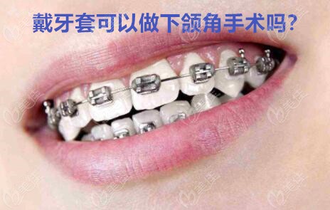 戴牙套可以做下颌角手术吗