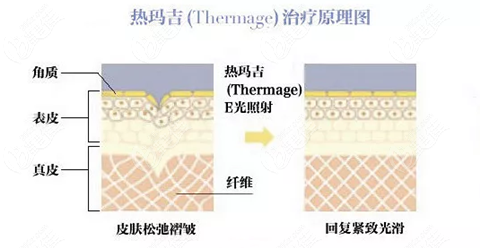 热玛吉的治疗原理