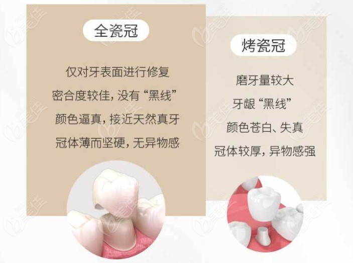 全瓷牙冠和烤瓷牙冠的区别了解下