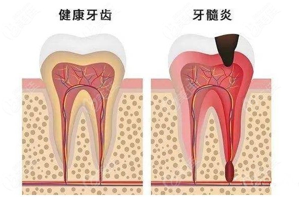 下图告诉您什么是牙髓炎