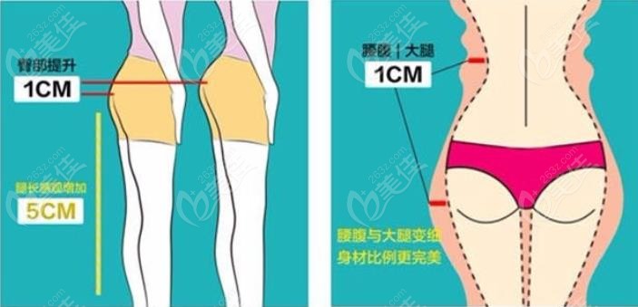 	大腿吸脂后臀部下垂怎么做可以提升臀线，要根据情况而定