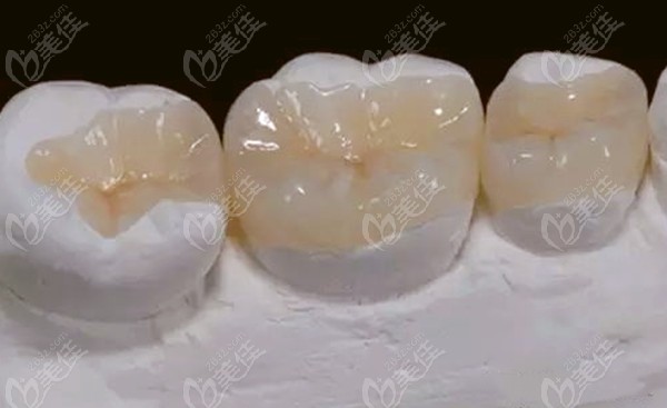 牙齿嵌体装好后能取下来吗