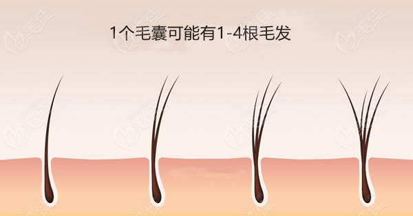 1个毛囊可能有1-4根头发