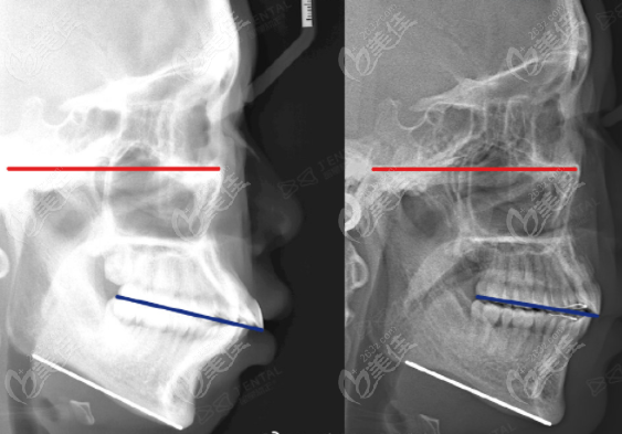 病例2——骨性龅牙内收7毫米