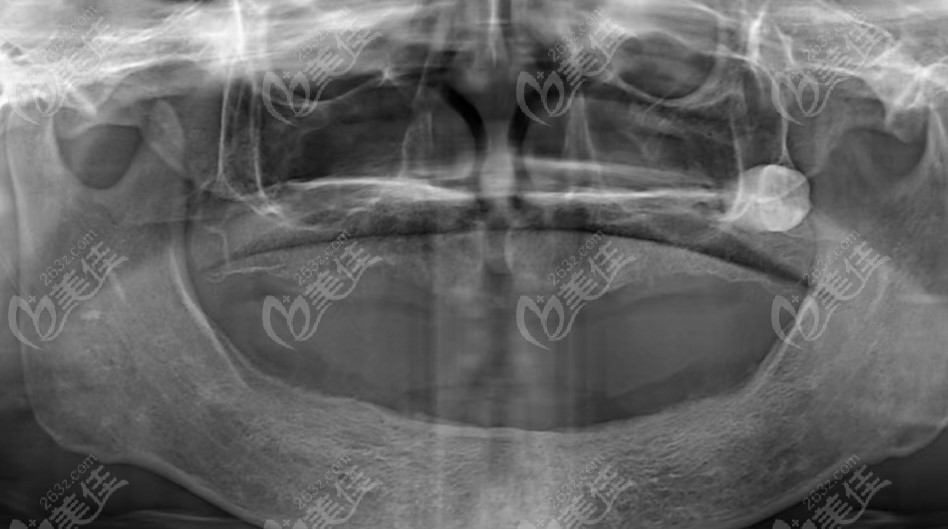 全口无牙颌的CT片