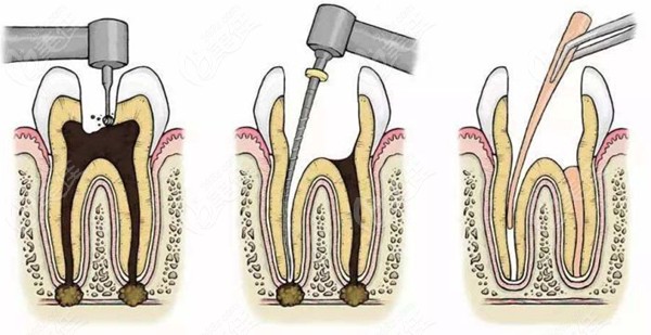 根管治疗填充根管的图