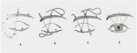 眉下筋膜悬吊手术步骤