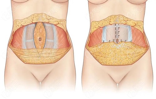 腹壁成型手术原理