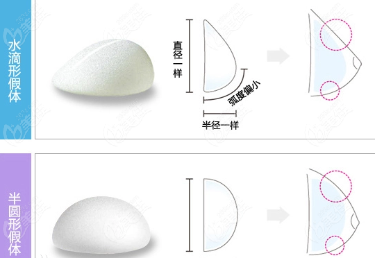 隆胸能摸到假体边缘正常吗