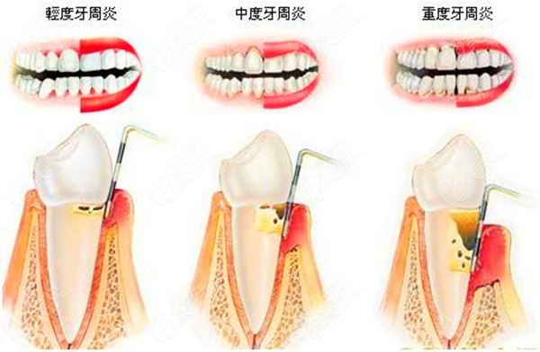 中度牙周炎图片