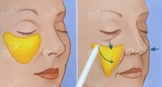 眼睑下方切口提升苹果肌