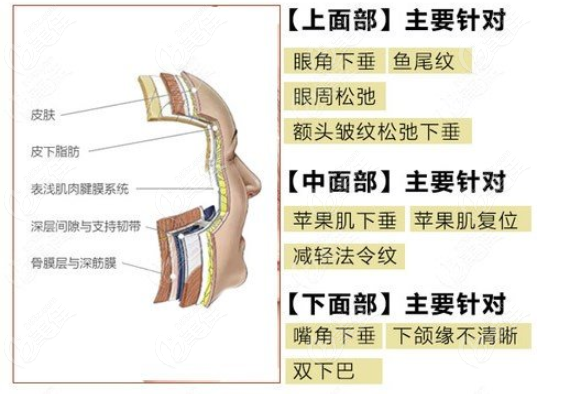 小切口拉皮可以改善面部松弛