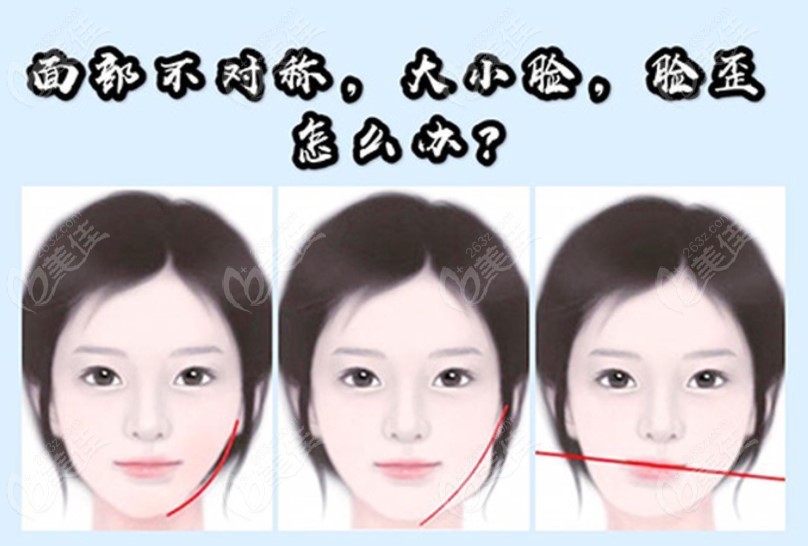 大小脸可以通过正颌手术来改善吗