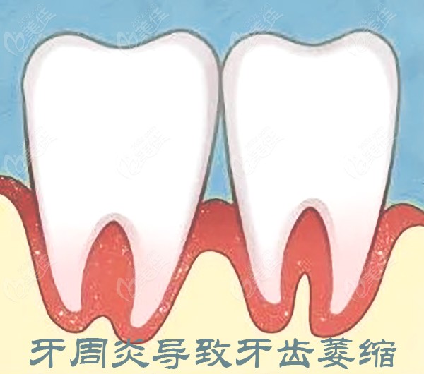 导致牙齿萎缩的牙周炎