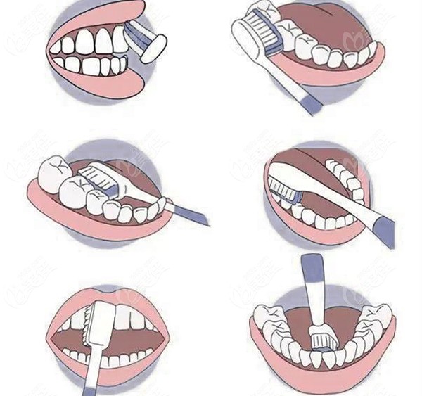 巴氏刷牙法恢复牙龈萎缩