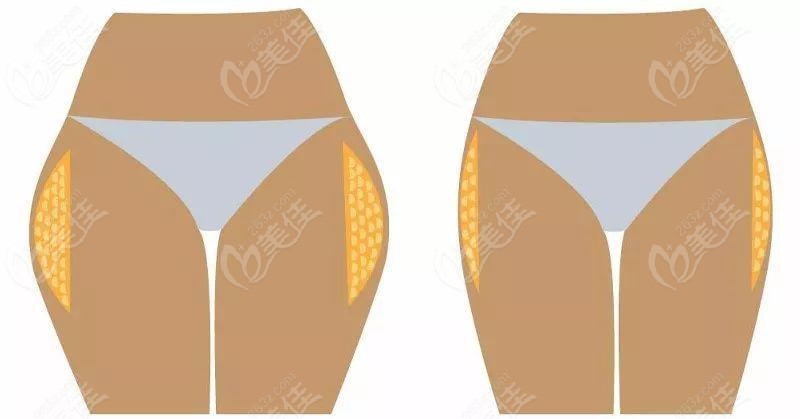 大腿吸脂對(duì)比照 大腿吸脂對(duì)比照