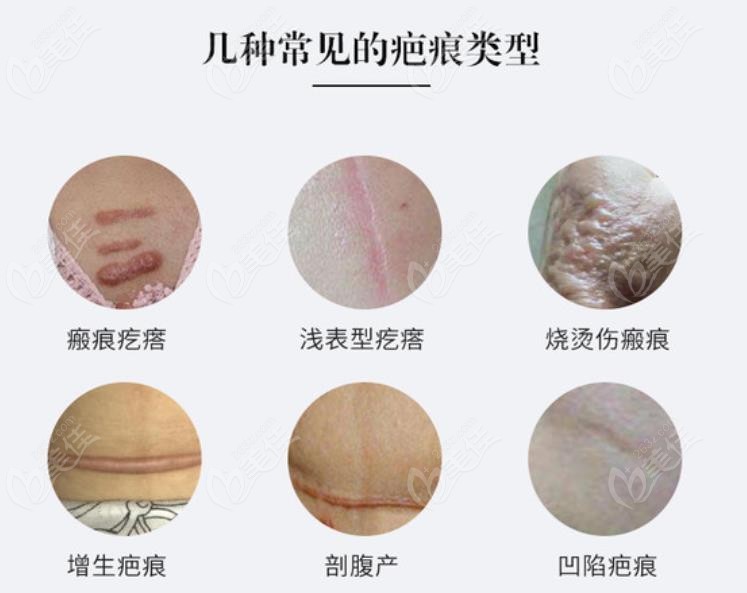 许昌治疗疤痕疙瘩正规的修复中心能做的疤痕类型