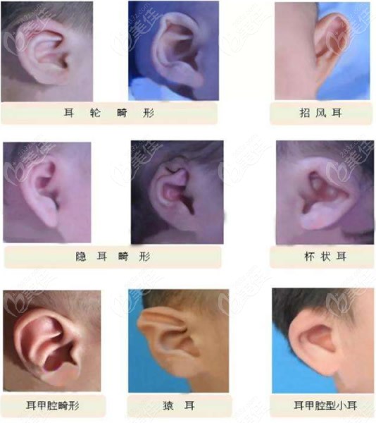 耳朵畸形的症状和图片