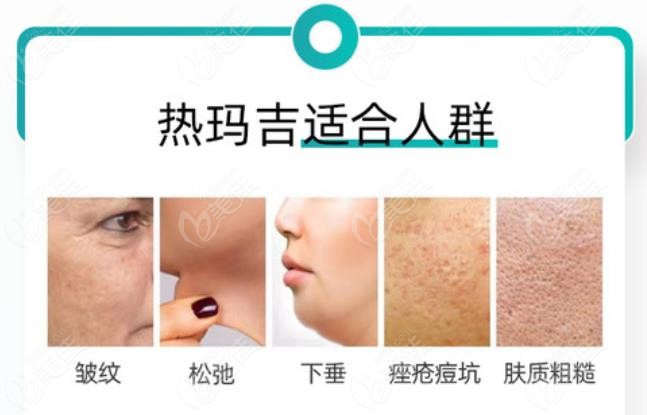 热玛吉适合人群与改善哪些问题