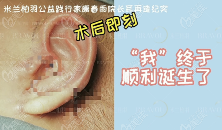 康春雨医生做耳再造手术术后即刻照
