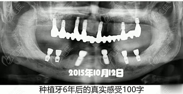 种植牙6年后的真实感受100字
