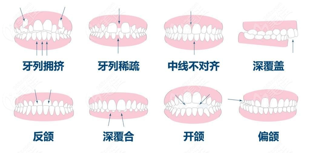 六杏口腔可矫正的畸形牙齿类型