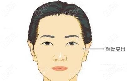 顴骨內(nèi)推手術(shù)要不要做要結(jié)合顴骨突出的實(shí)際問題來定