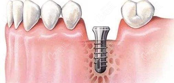 种植有关牙槽骨的图