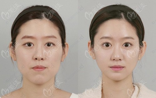 韩国ID整形院v-line和双鄂手术前后对比