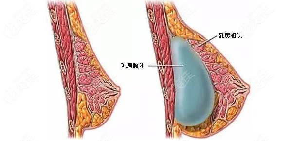 隆胸假体过程图片图片