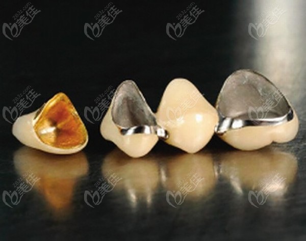 艮卦治疗后补牙或者戴牙套的价格