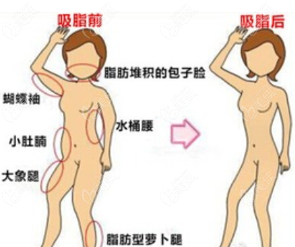 石家庄美莱整形医院做吸脂手术好不好