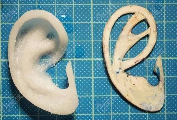 北京丽都做Su-por生物支架一次成型耳再造手术优势